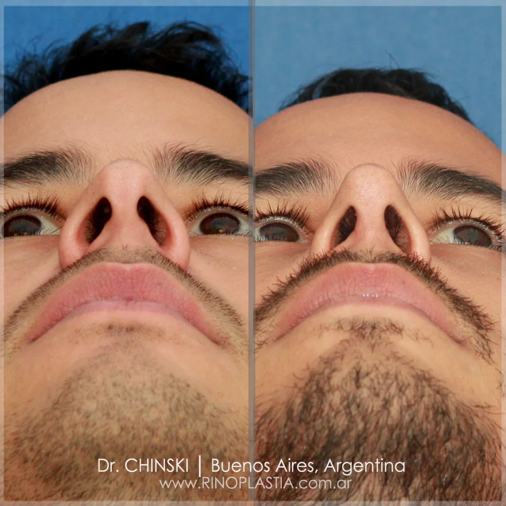 Antes e depois de rinoplastia – caso 188