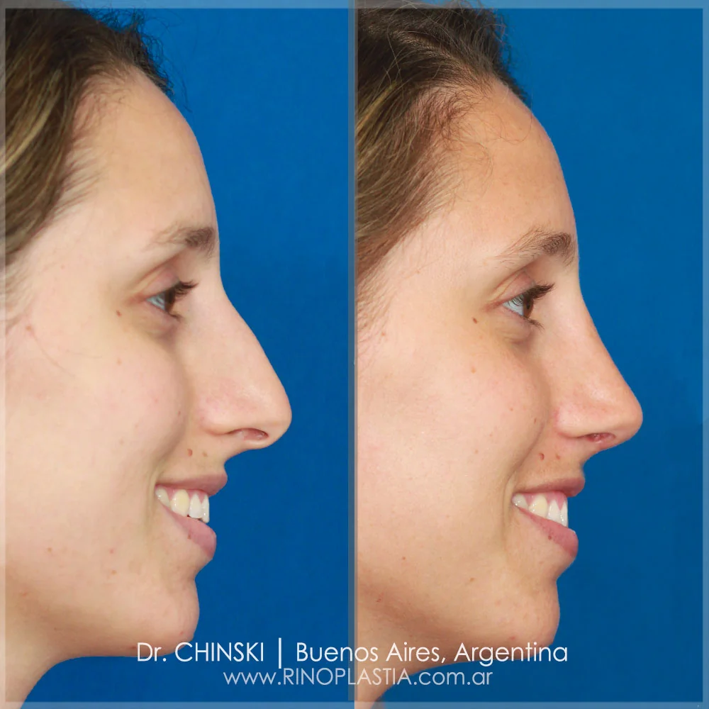 Antes e depois de rinoplastia – caso 189