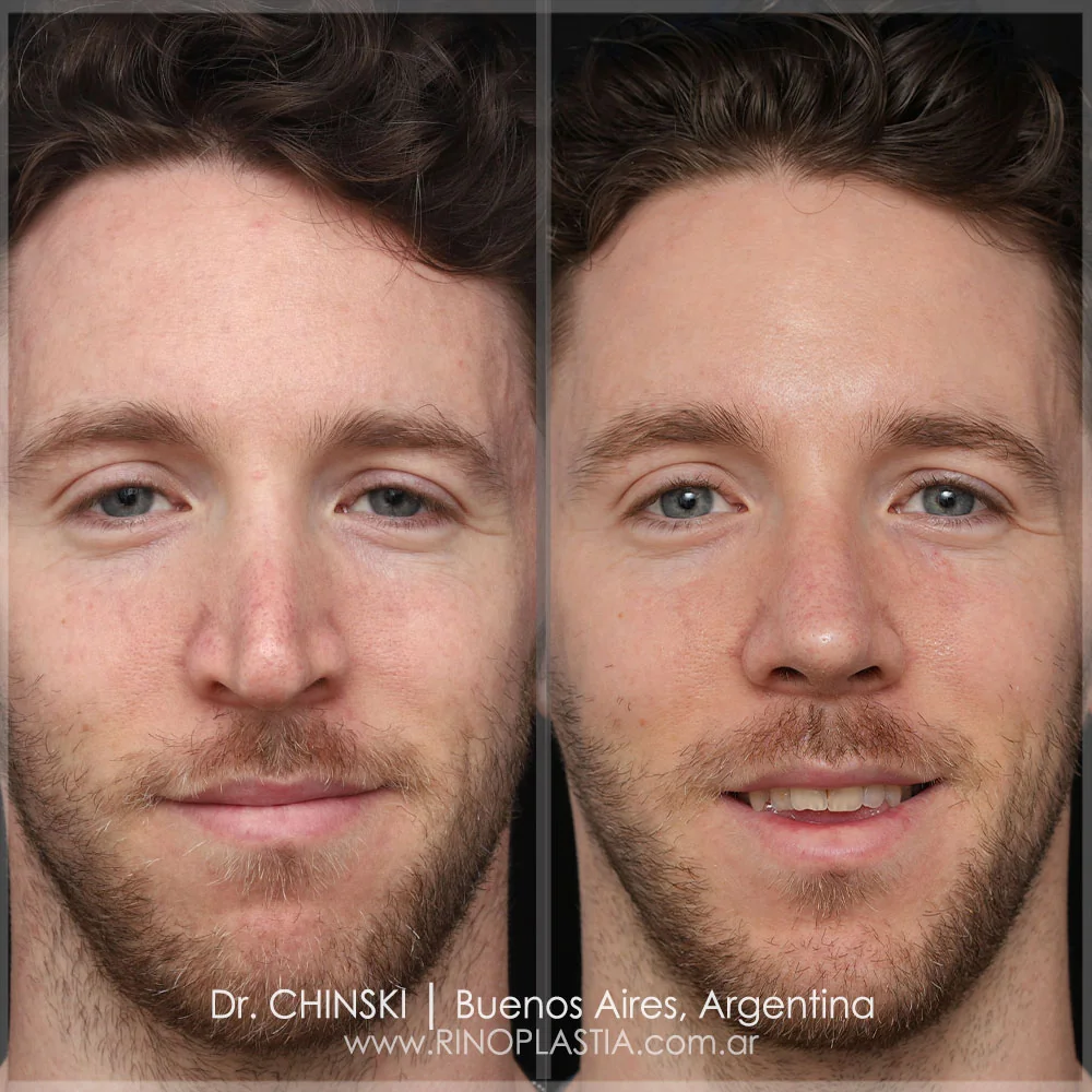 Rhinoplasty before and after – case 19