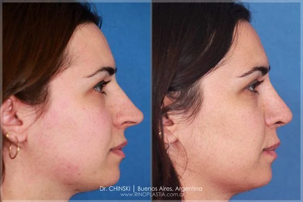 Antes e depois de rinoplastia – caso 190