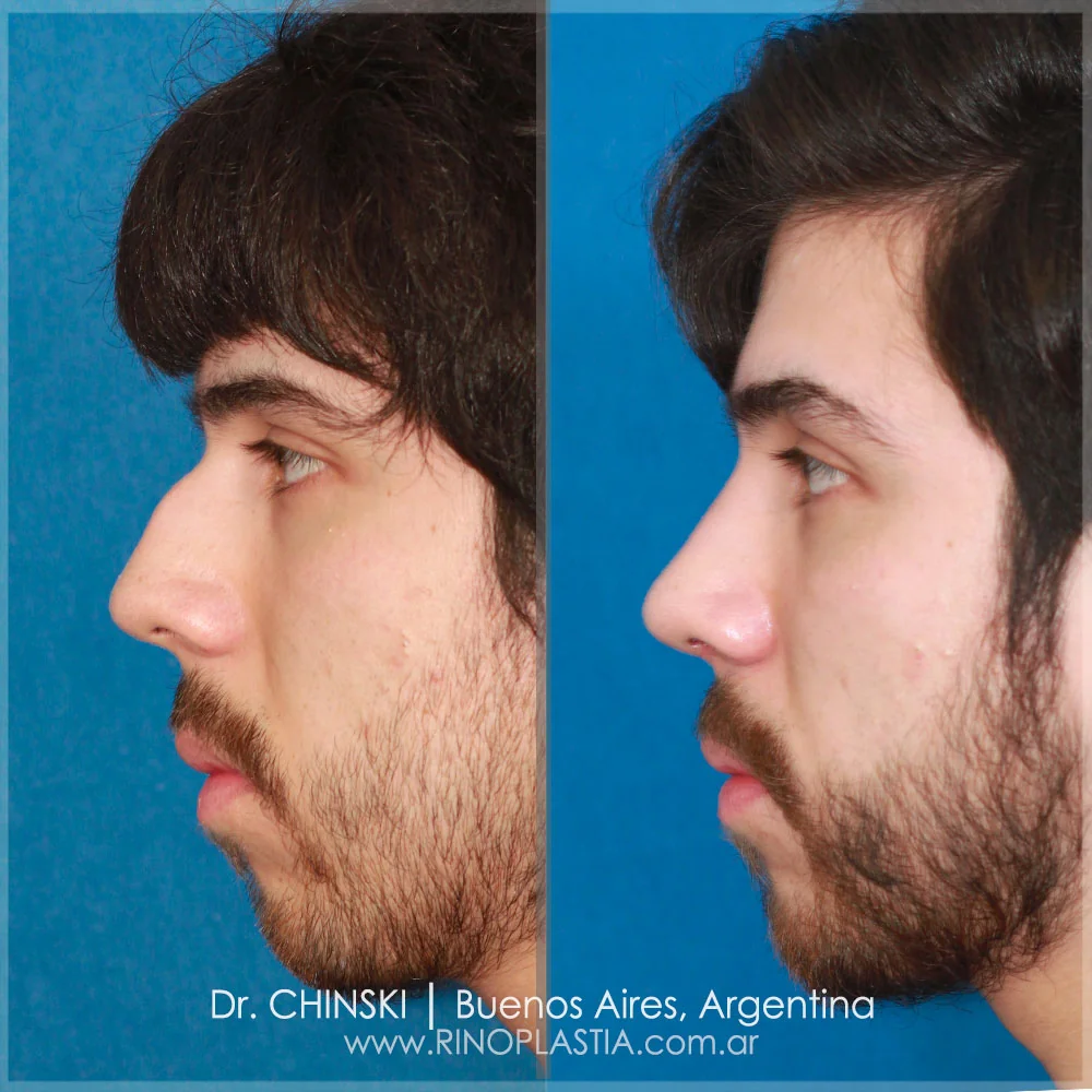 Rhinoplasty before and after – case 191