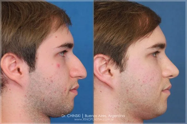 Rhinoplasty before and after – case 192