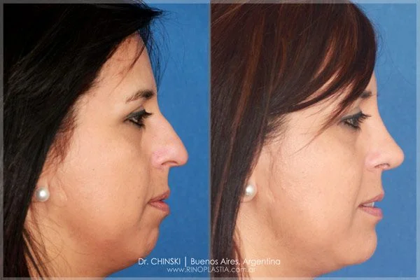 Rhinoplasty before and after – case 193