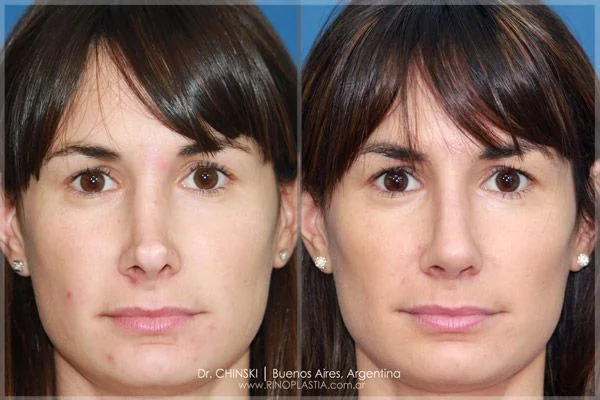 Rhinoplasty before and after – case 194