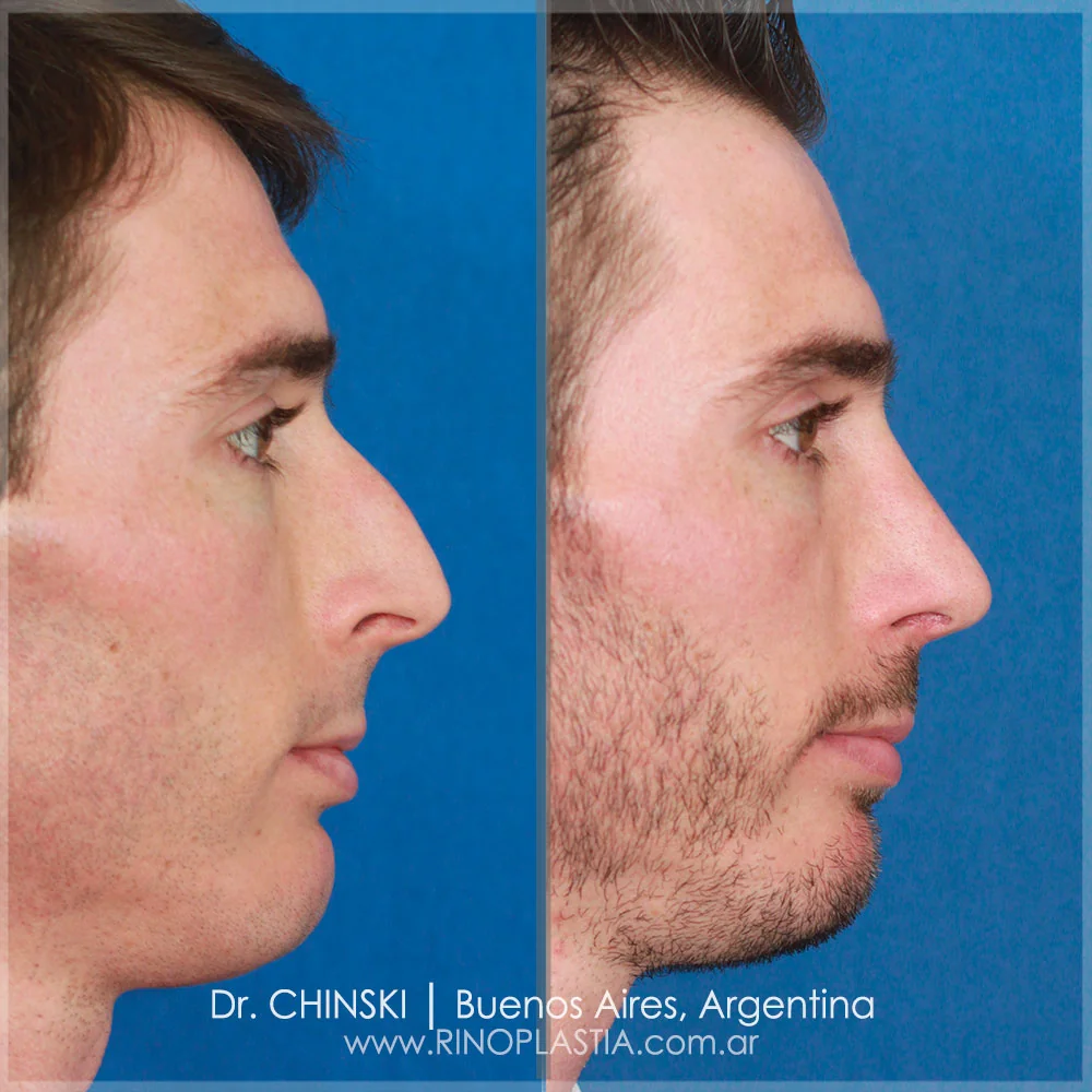 Rhinoplasty before and after – case 195