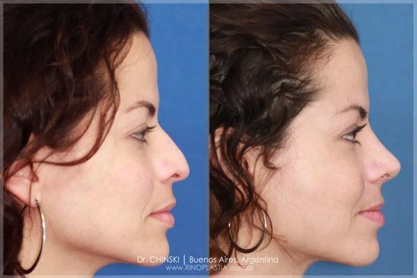 Antes e depois de rinoplastia – caso 196