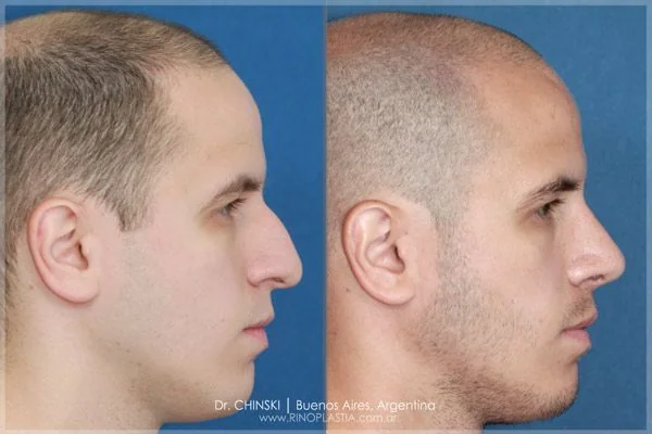 Antes e depois de rinoplastia – caso 197