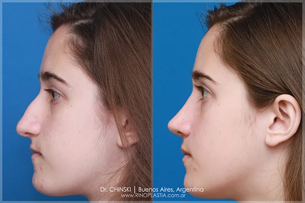 Antes y después de rinoplastia – caso 198