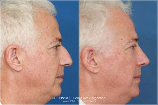 Rhinoplasty before and after – case 199