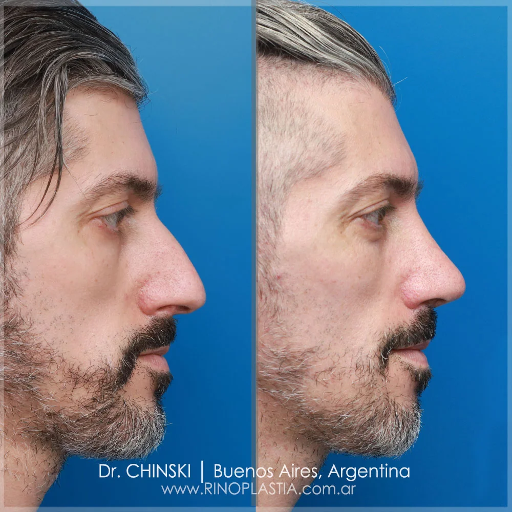 Rhinoplasty before and after – case 20