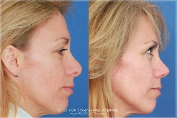 Rhinoplasty before and after – case 200