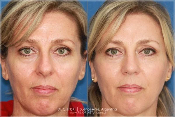 Rhinoplasty before and after – case 201