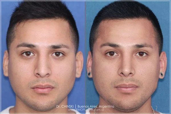 Antes e depois de rinoplastia – caso 202