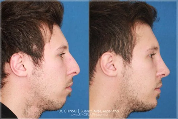 Antes e depois de rinoplastia – caso 203