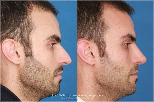 Antes e depois de rinoplastia – caso 204
