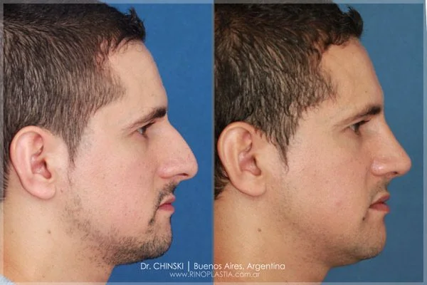 Antes y después de rinoplastia – caso 205