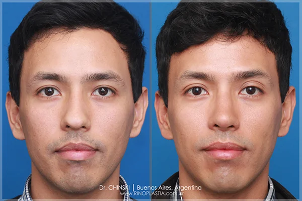 Rhinoplasty before and after – case 206