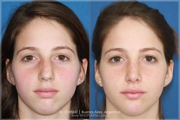 Antes e depois de rinoplastia – caso 207