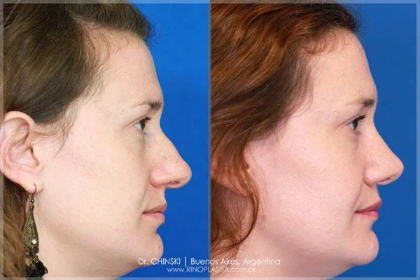 Antes e depois de rinoplastia – caso 208
