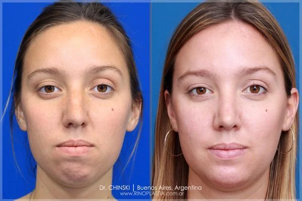 Rhinoplasty before and after – case 209