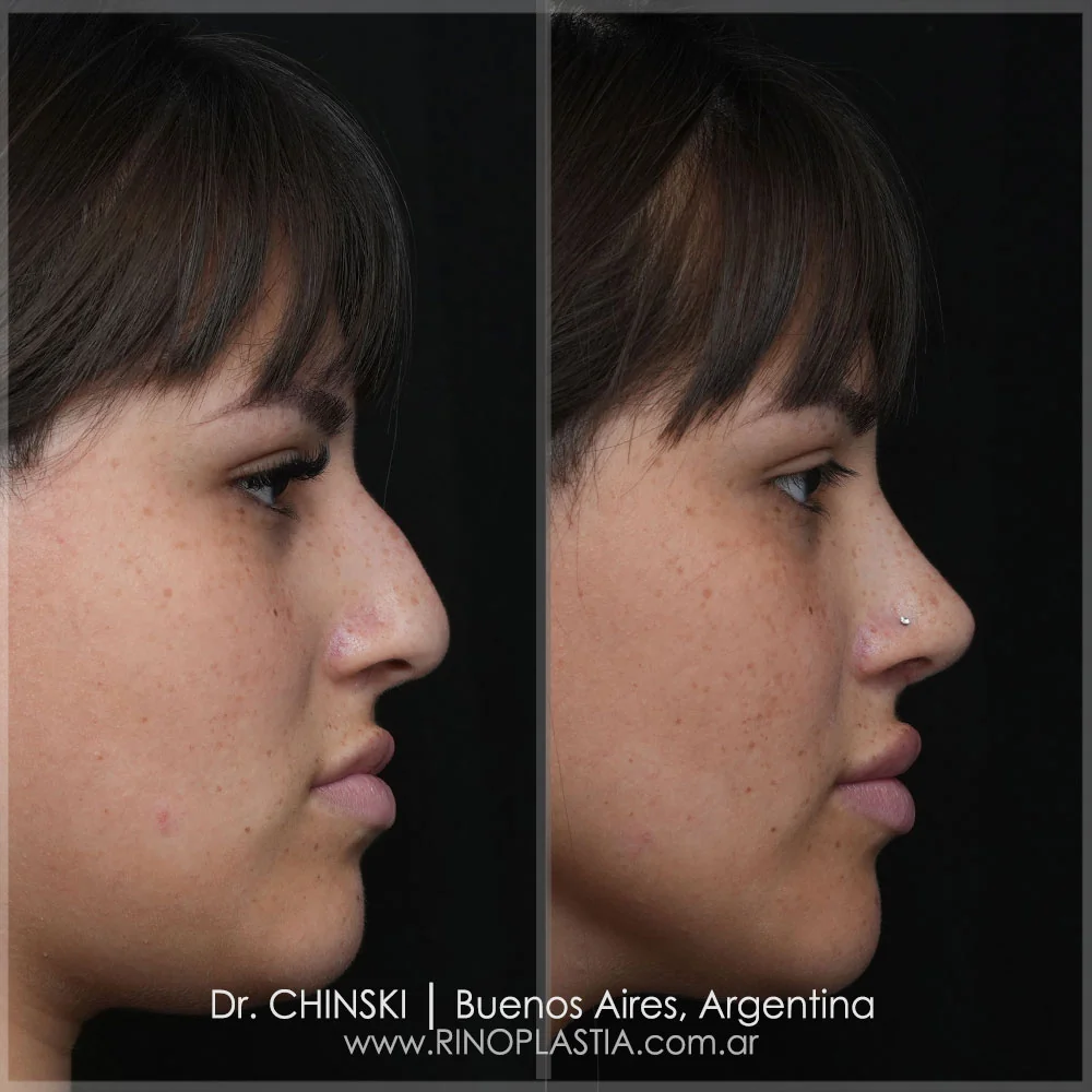 Rhinoplasty before and after – case 21