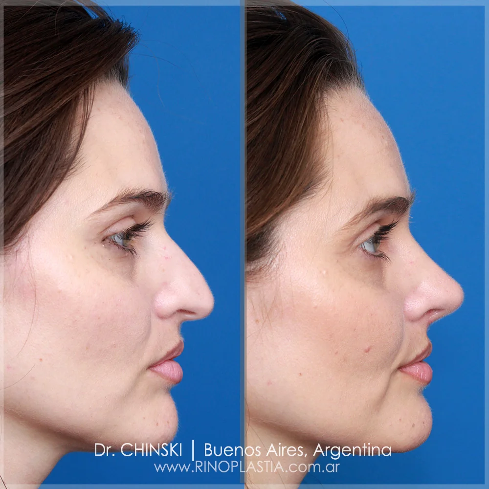 Rhinoplasty before and after – case 210