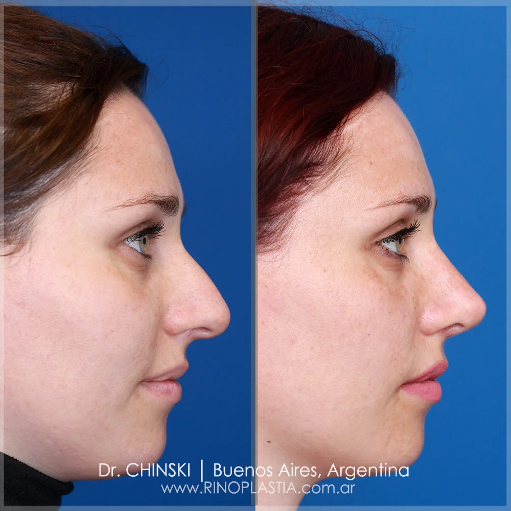 Rhinoplasty before and after – case 211