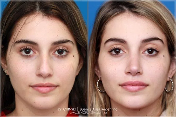 Rhinoplasty before and after – case 212