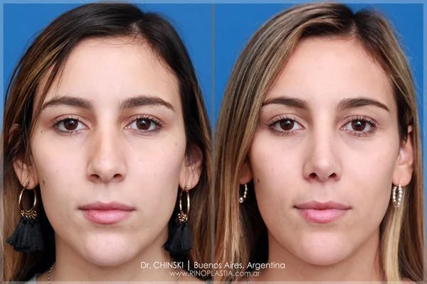 Antes y después de rinoplastia – caso 213