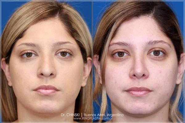 Antes e depois de rinoplastia – caso 214