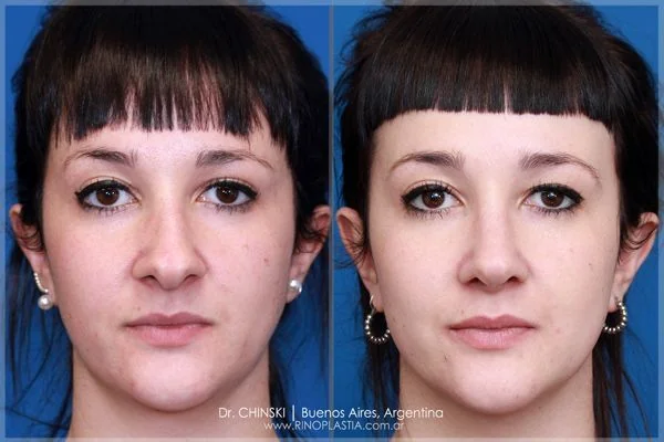 Rhinoplasty before and after – case 215
