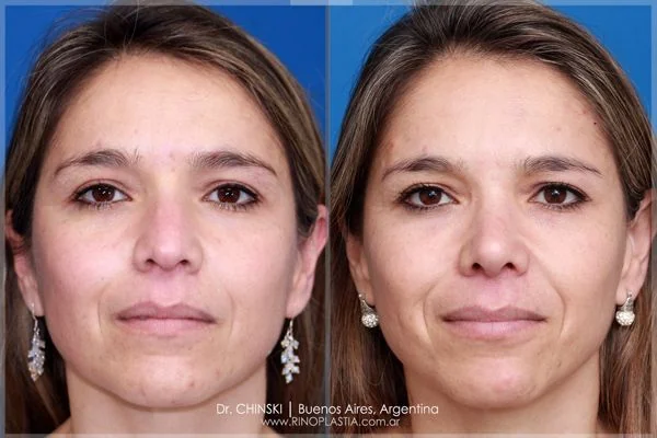 Antes y después de rinoplastia – caso 216