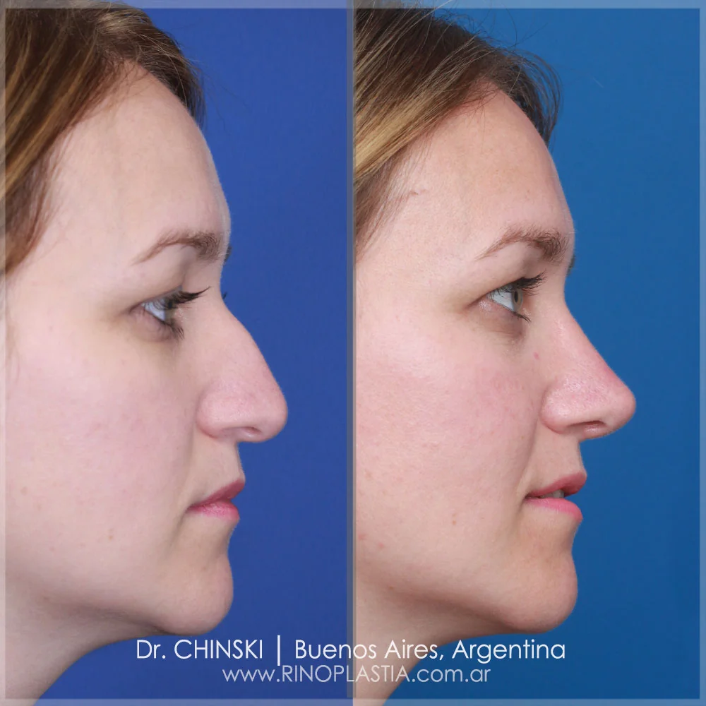 Antes e depois de rinoplastia – caso 217