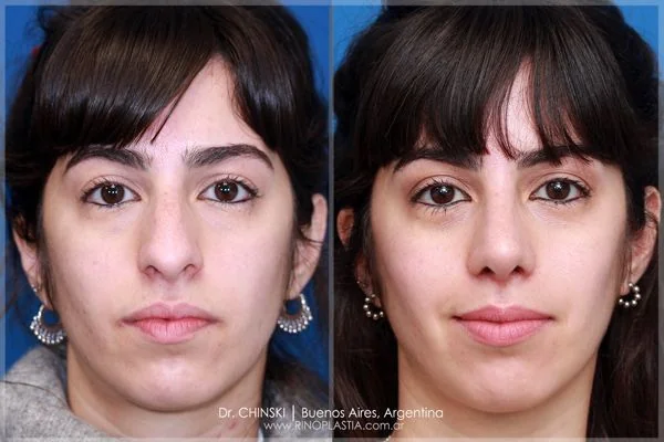 Rhinoplasty before and after – case 218