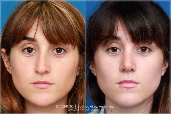 Antes e depois de rinoplastia – caso 219