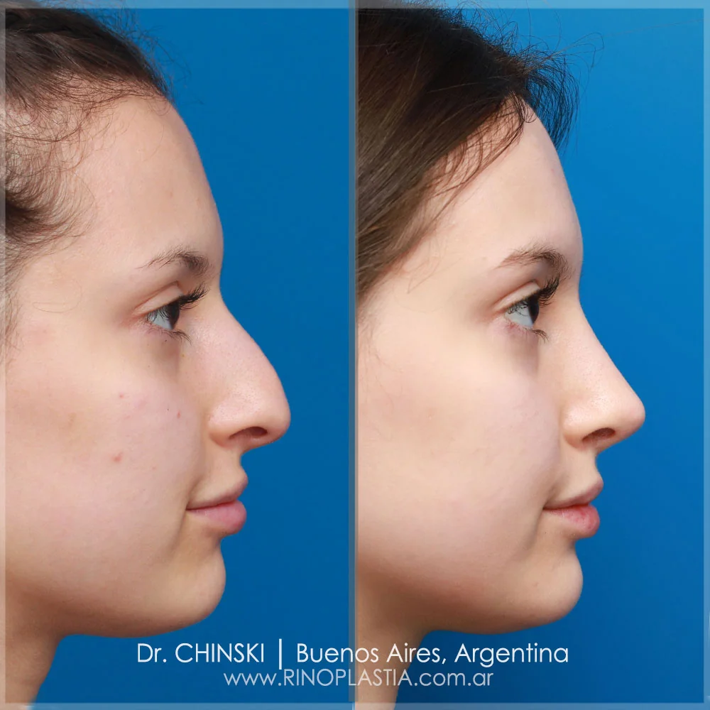 Rhinoplasty before and after – case 22