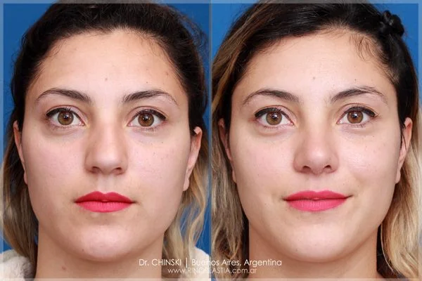 Antes e depois de rinoplastia – caso 220