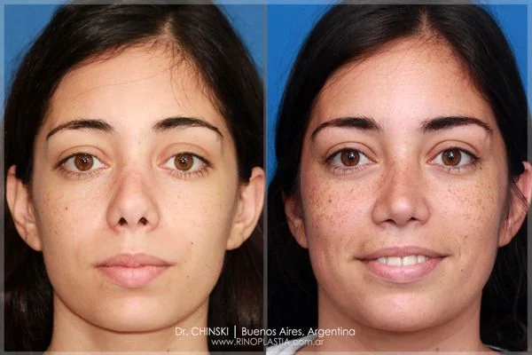 Antes y después de rinoplastia – caso 221