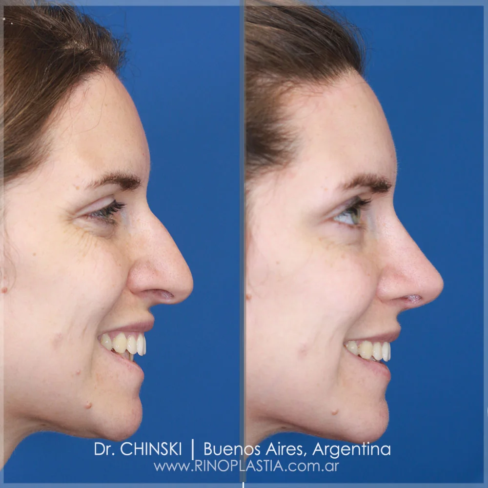 Antes e depois de rinoplastia – caso 222