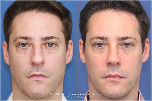 Antes y después de rinoplastia – caso 223