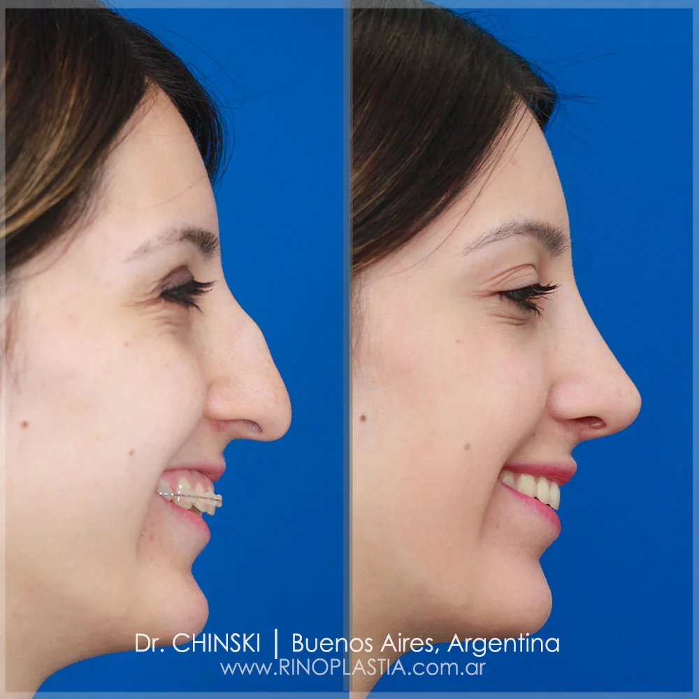 Antes e depois de rinoplastia – caso 224