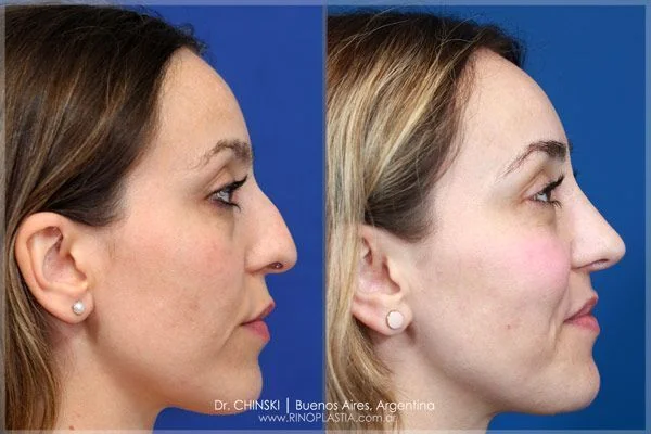 Antes y después de rinoplastia – caso 225