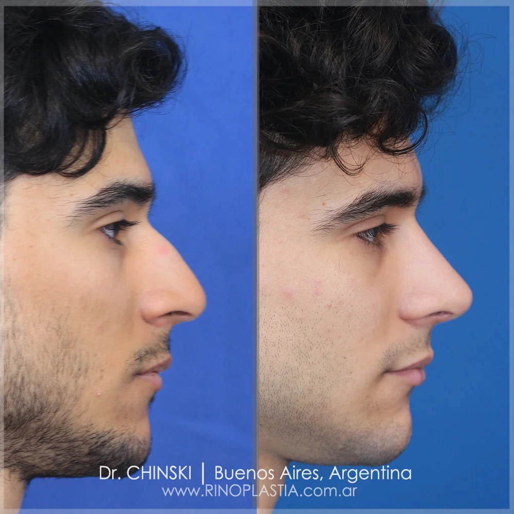 Antes y después de rinoplastia – caso 226