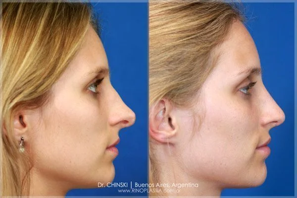 Antes e depois de rinoplastia – caso 227