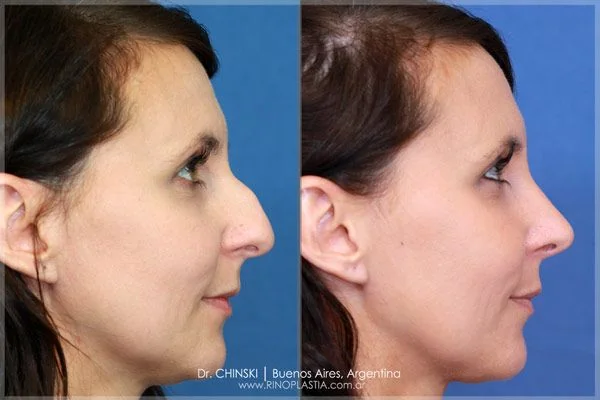 Rhinoplasty before and after – case 228