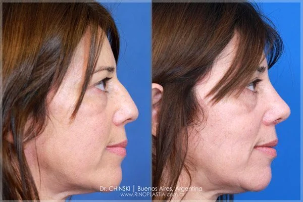 Antes e depois de rinoplastia – caso 229