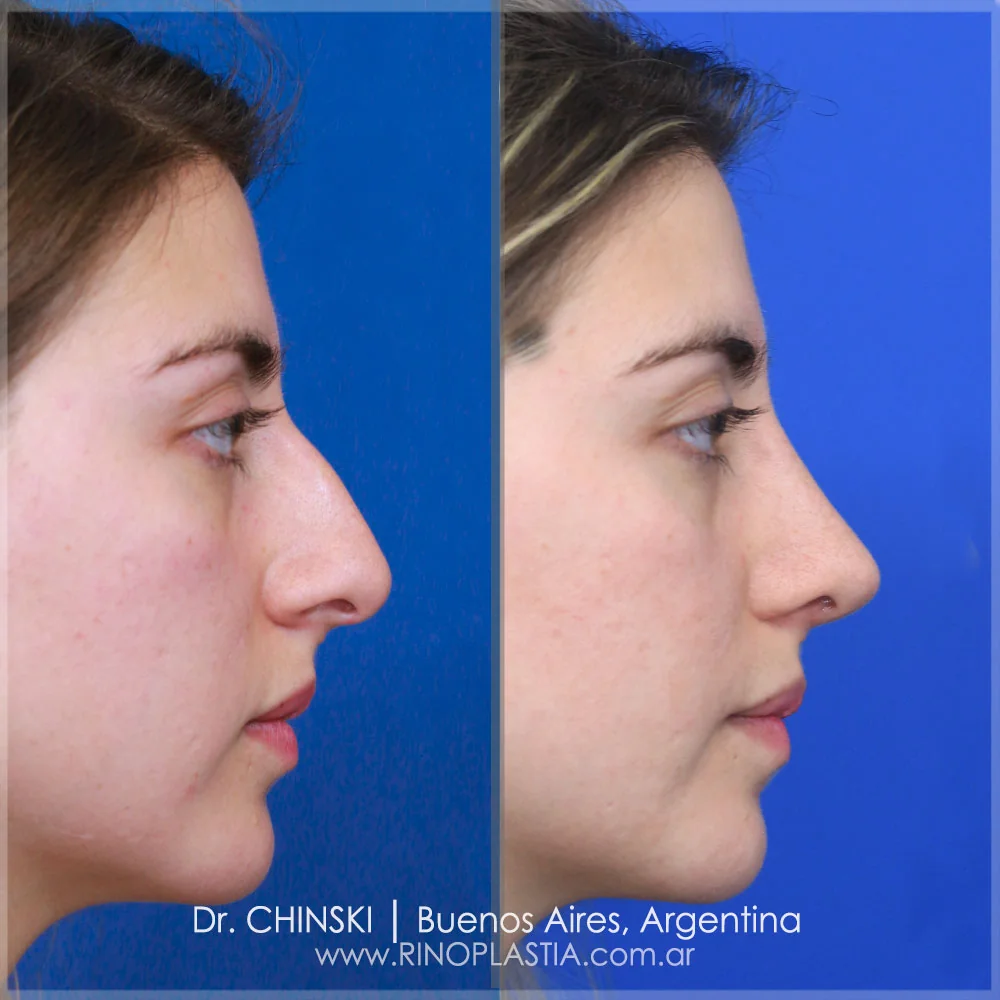 Antes e depois de rinoplastia – caso 230