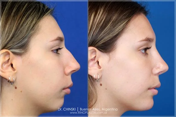 Antes e depois de rinoplastia – caso 231