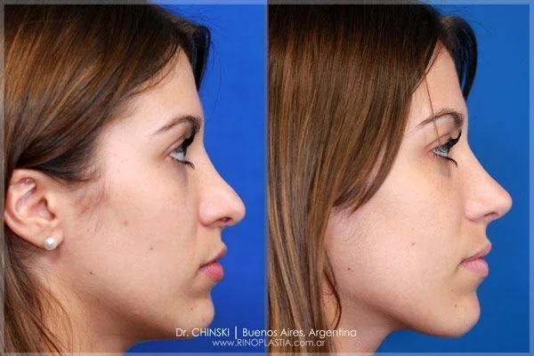 Rhinoplasty before and after – case 232