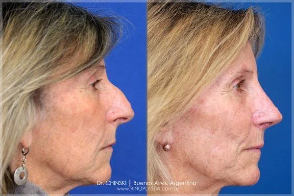 Antes e depois de rinoplastia – caso 233
